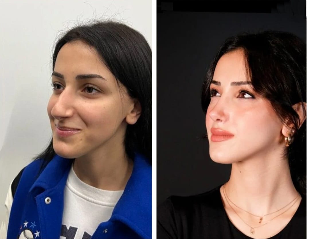 Rinoplastia caso 9 — antes y después
